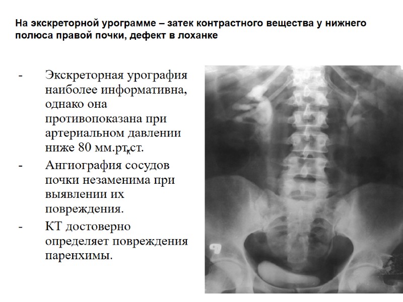 Экскреторная урография наиболее информативна, однако она противопоказана при артериальном давлении ниже 80 мм.рт.ст. Ангиография